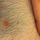 Image for article titled Woman Grows Full Size Nipple On Foot